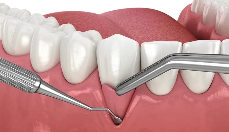 Periodontal Surgery