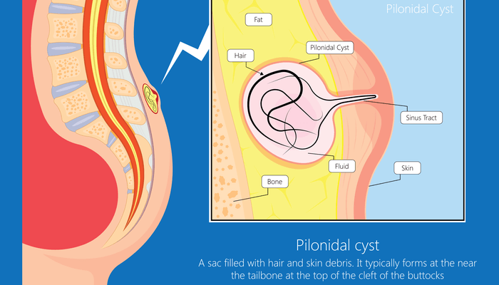 Pilonidal Sinus Treatment Methods Drhc Dubai Hemorrhoids Clinic
