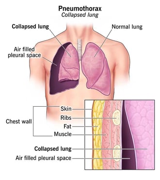 Thoracic surgery | Dr. Rami Hamed Center /Pneumothorax