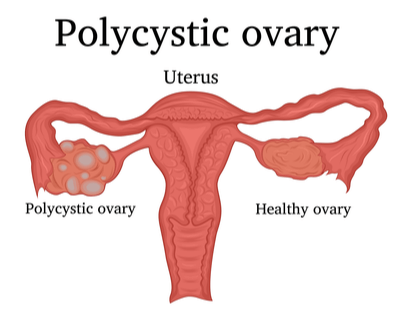 Polycystic Ovaries  DRHC Dubai Gynecology Clinic