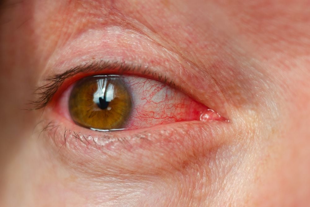 Red eye treatment in dubai