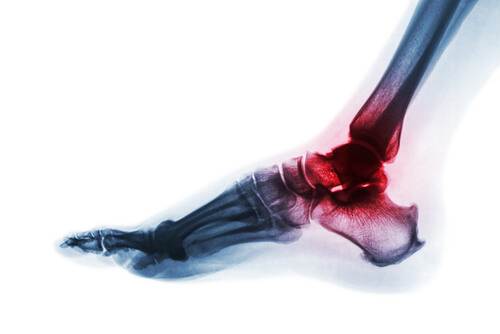 Rheumatoid Arthritis - DRHC Dubai Orthopedic Clinic