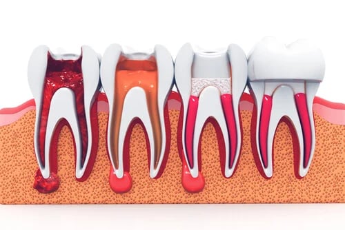 Root Canal Treatment