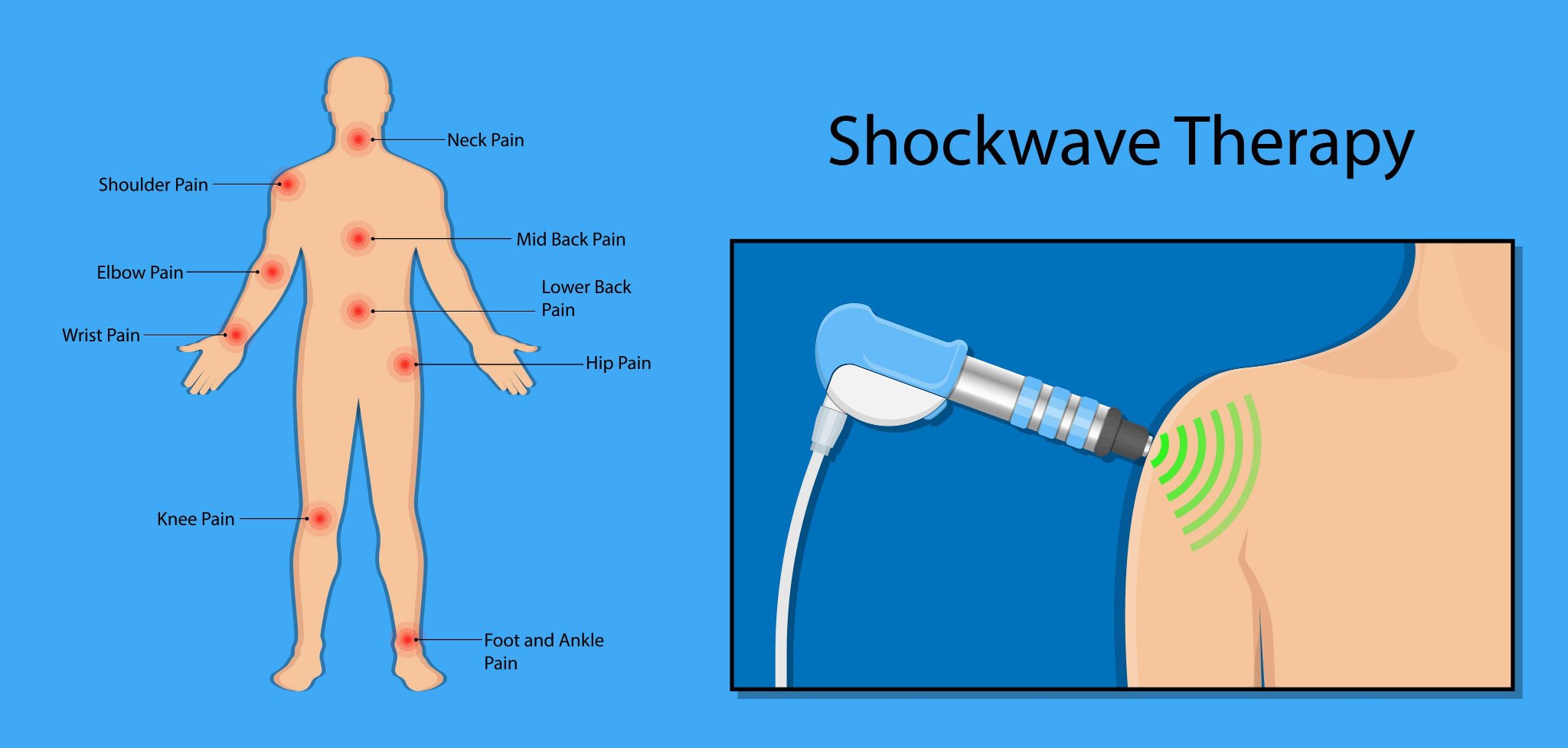 Shockwave_Therapy_DRHC_BEST_HOSPITSL_IN_DUBAI