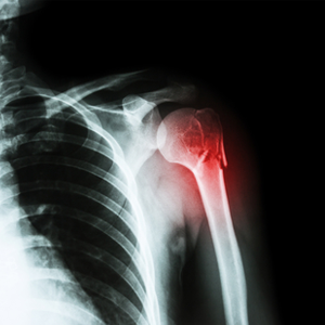 Shoulder Replacement Surgery Shoulder Replacement Surgery