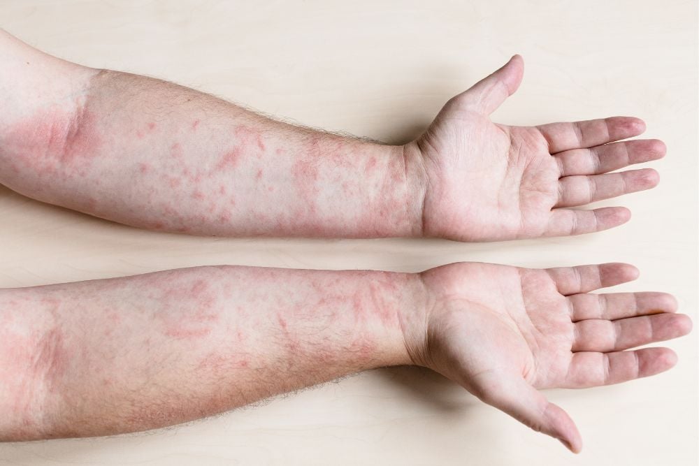 Skin Rash Treatment