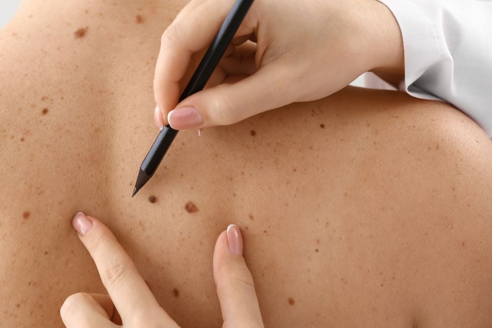 Skin Tag and Wart Removal
