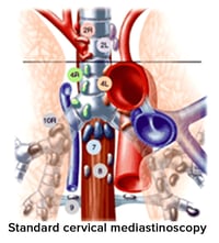 Standard cervical mediastinoscopy