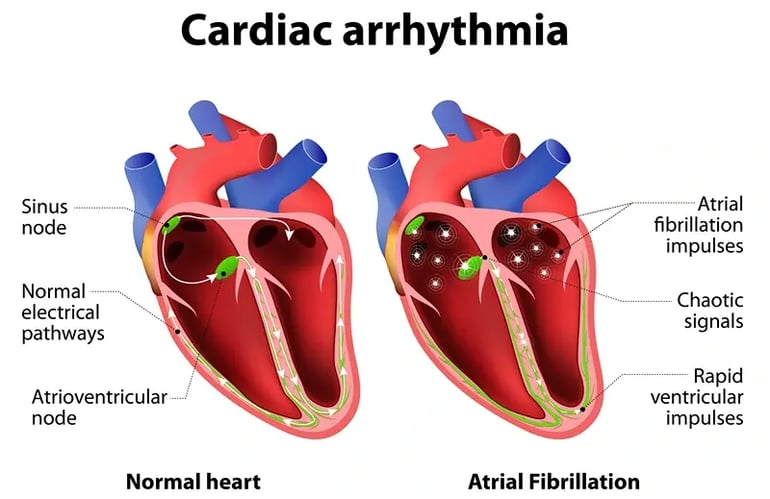 Stroke and Heart Disease