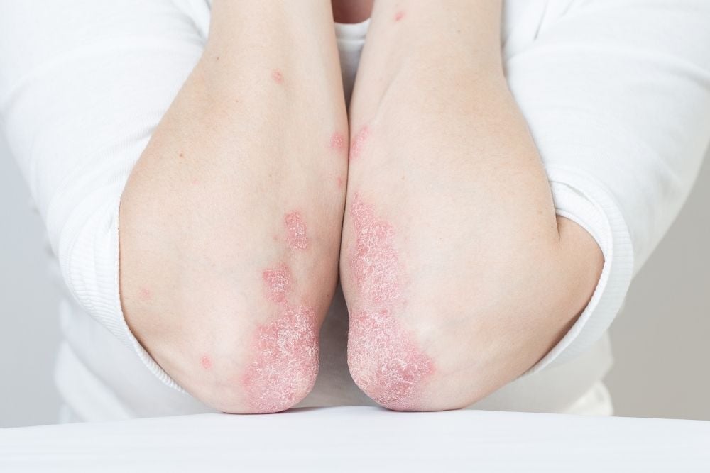 Systemic treatment of psoriasis