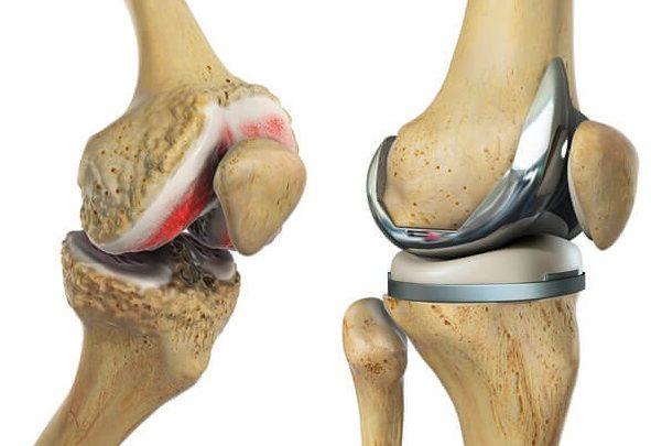 Total-Knee-Arthroplasty