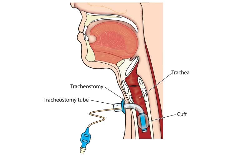 Tracheostomy Procedures