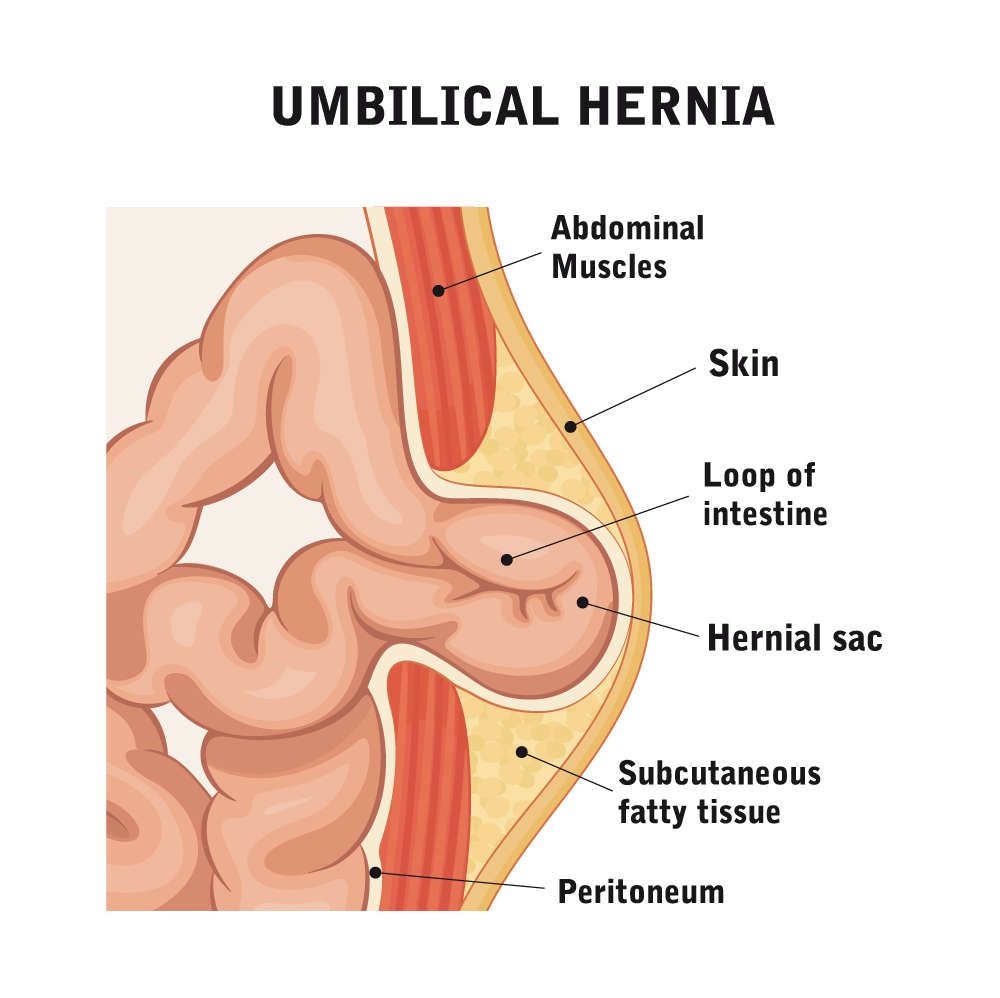 Umbilical-Hernia-[Converted]
