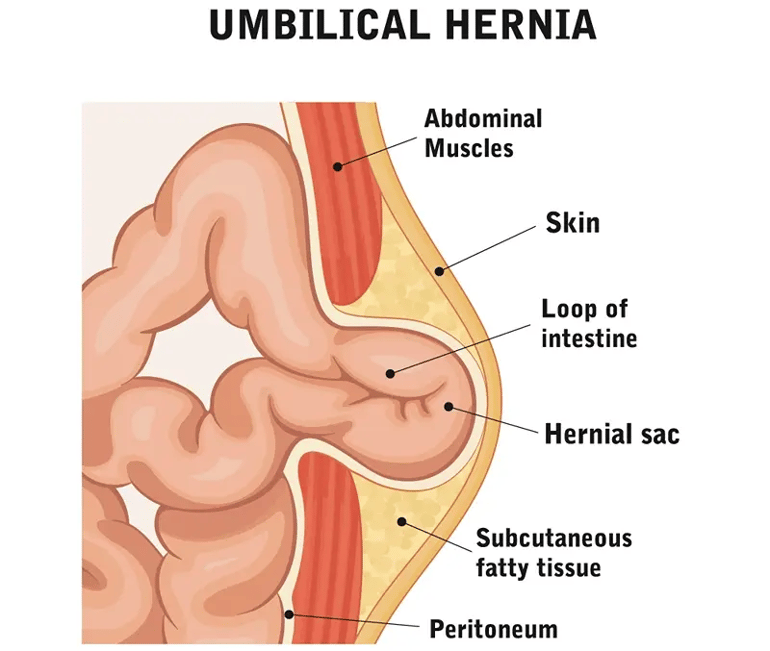 Umbilical-Hernia-drhc-dubai