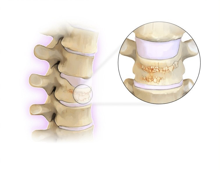 Vertebroplasty