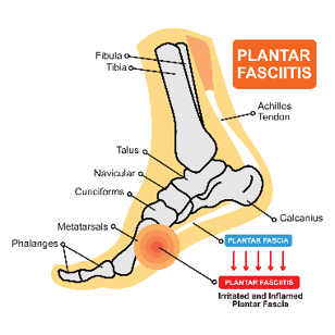 acrutefoot2 - DRHC Dubai Pediatric Cliic