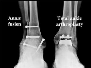 ankle replacement