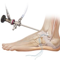 anterior-ankle-artrhoscopy