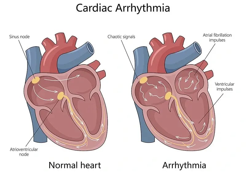Arrhythmia