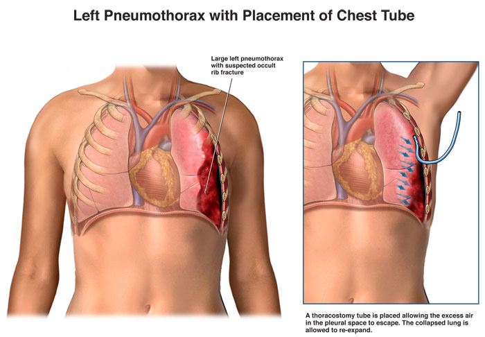 chest-tube-placement