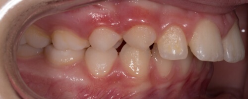Treatment of class 2 division 2 malocclusion