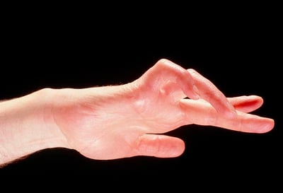 claw-hand-due-to-trapped-ulnar-nerve