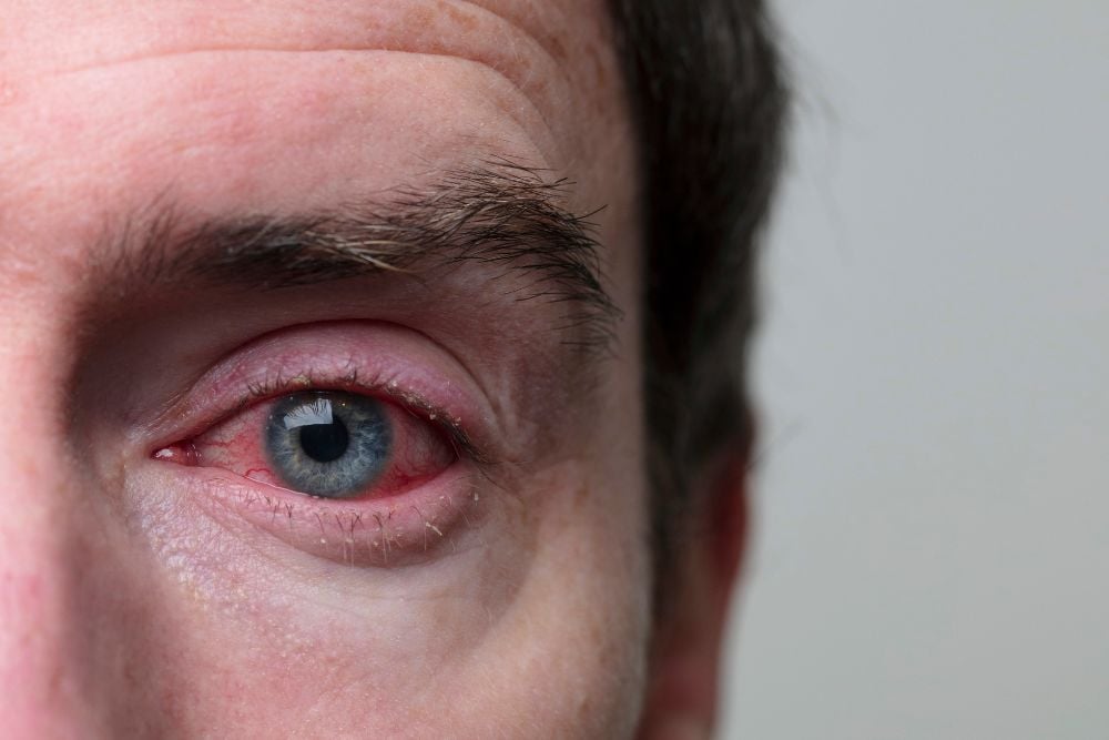 conjunctivitis eye Treatment at DRHC
