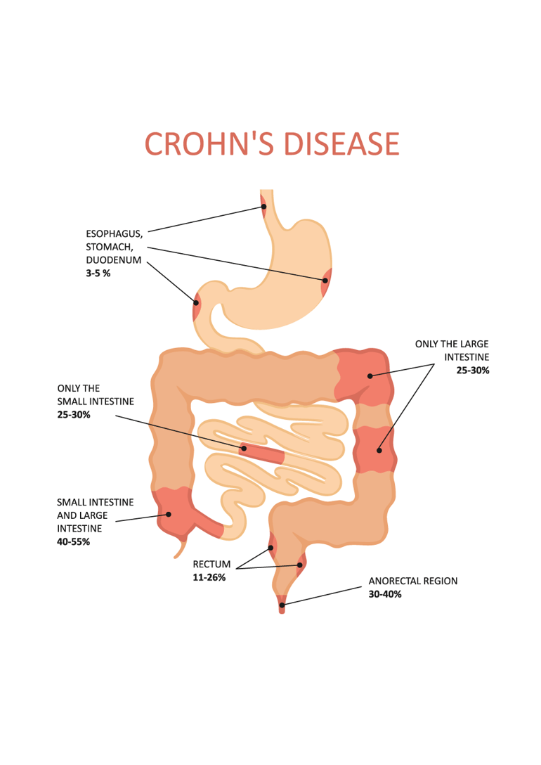 crohns-disease-[Converted]