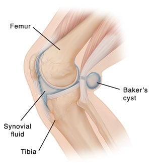 Bakers cyst