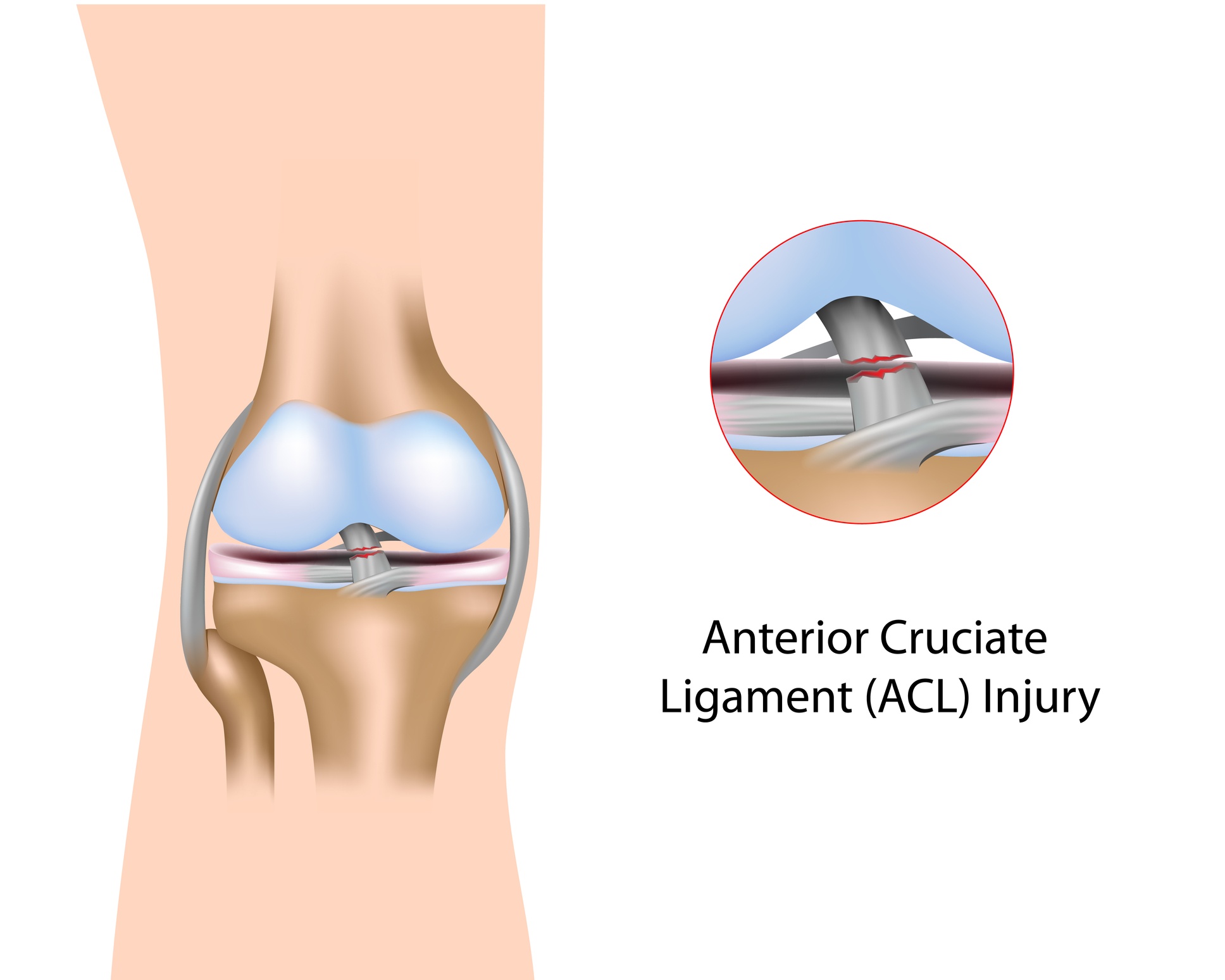 acl tear picture.jpg
