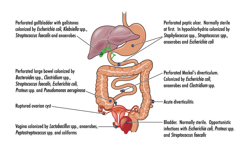 Perforated Gall Bladder | Dubai General Surgery Clinic