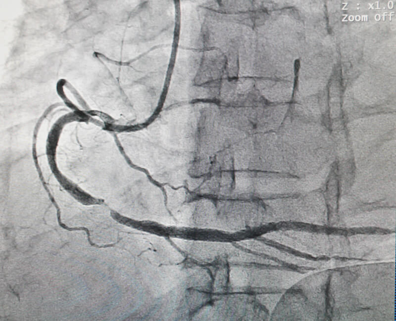 Coronary Angiography and Stenting