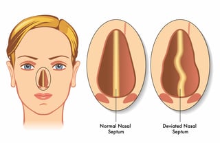 Deviated Nasal Septum
