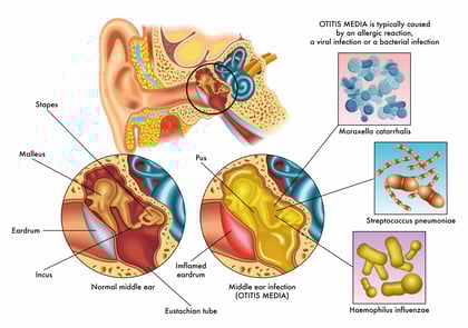 Otitis Media with Effusion