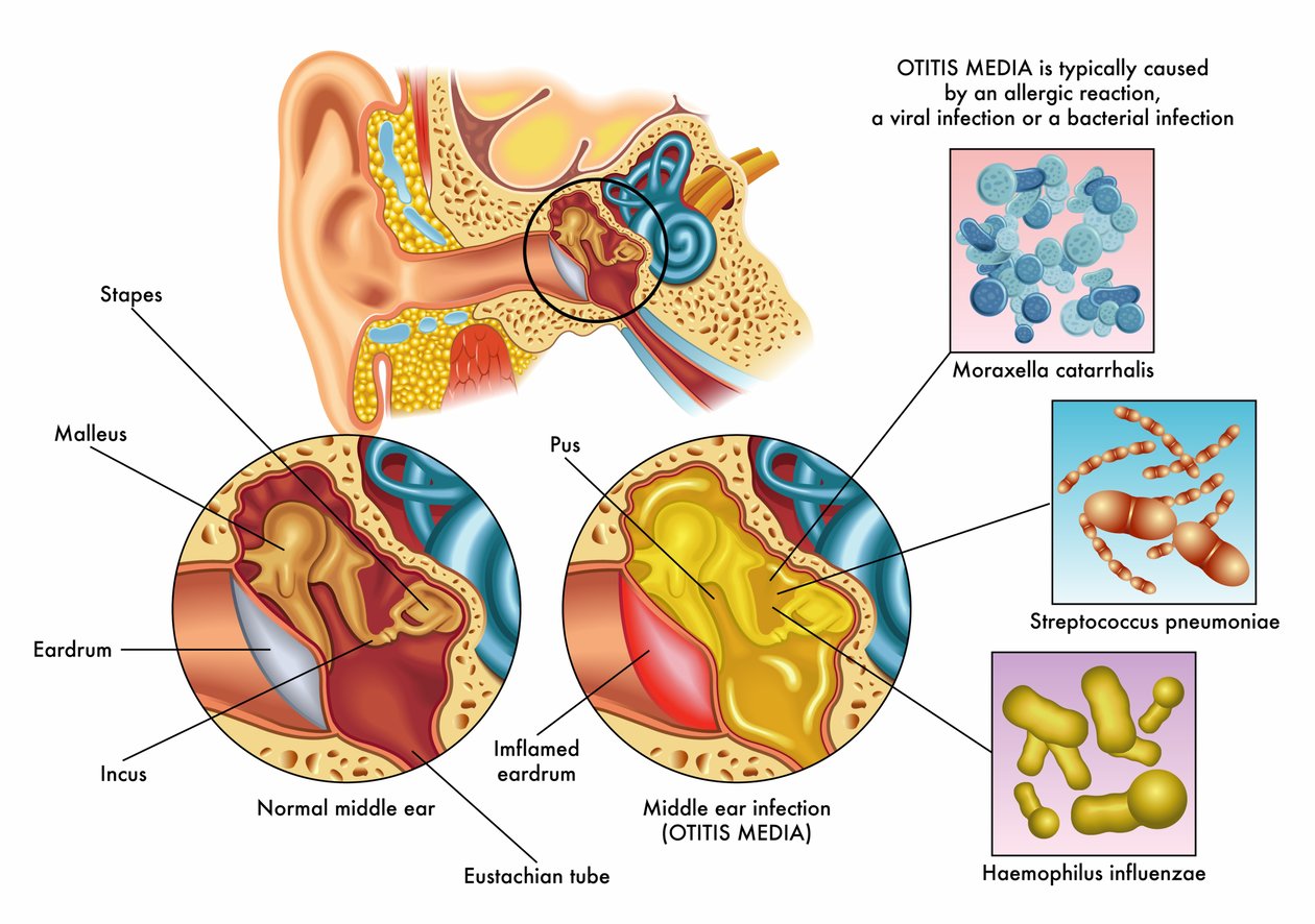 otitis media with effusion case study