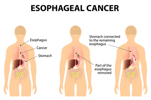 Oesophagus cancer
