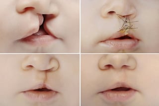 Cleft Lip Surgery Cleft Lip Surgery