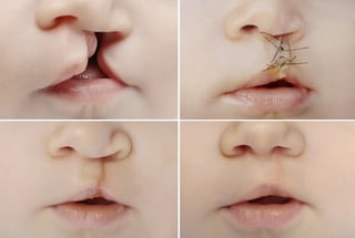 Cleft Lip Surgery