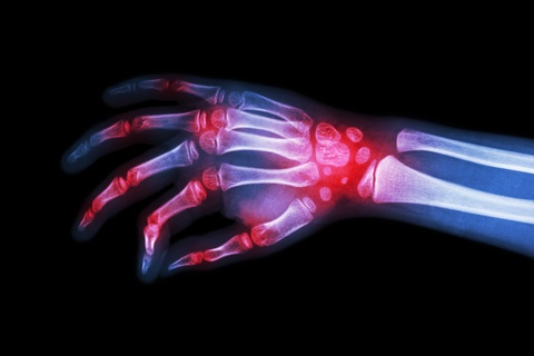 Hand Arthritis