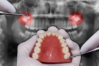Wisdom Teeth Removal Wisdom Teeth Removal
