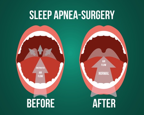 Uvulopalatopharyngoplasty