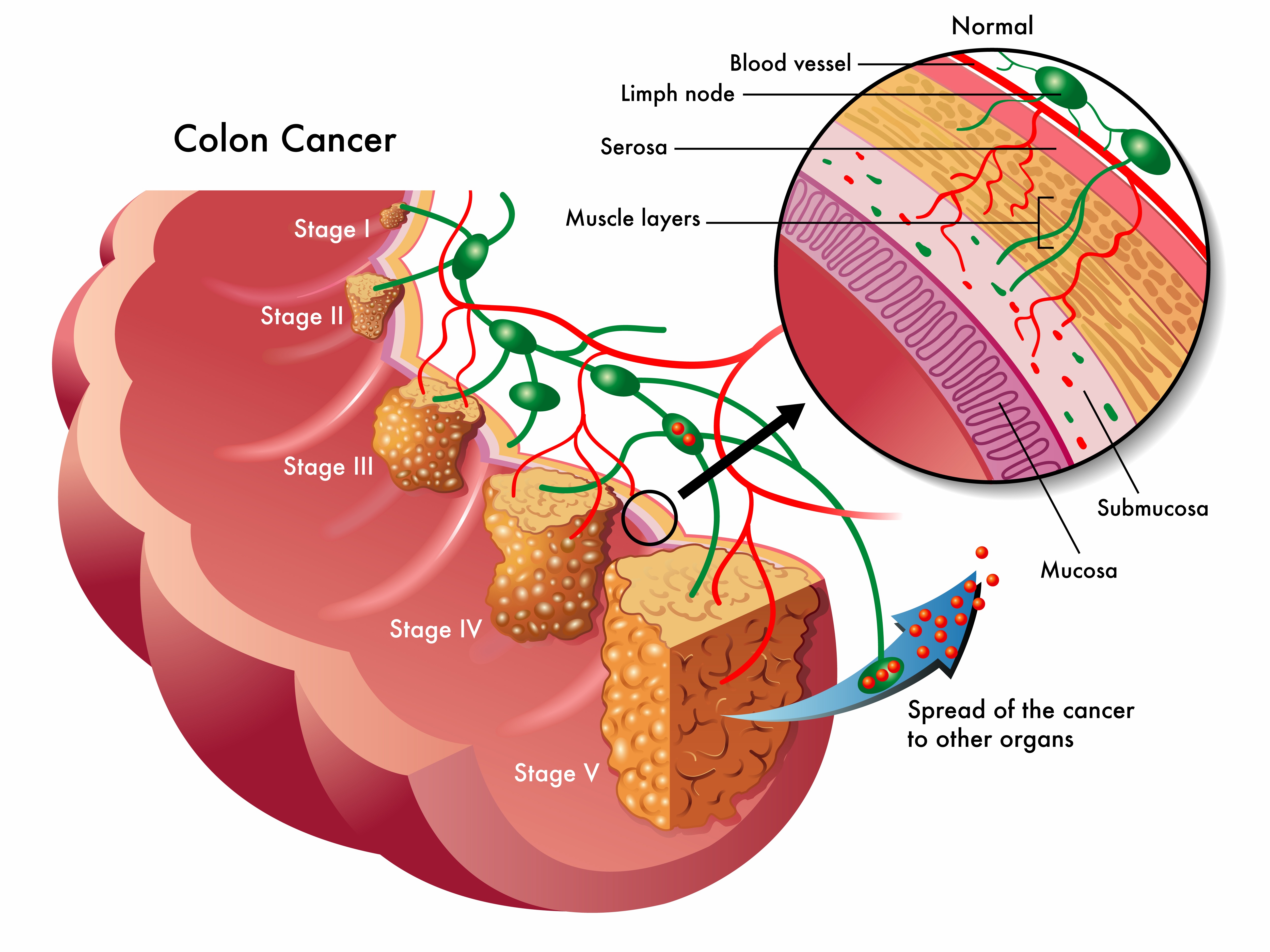 simple-best-diet-for-colon-cancer-youtube