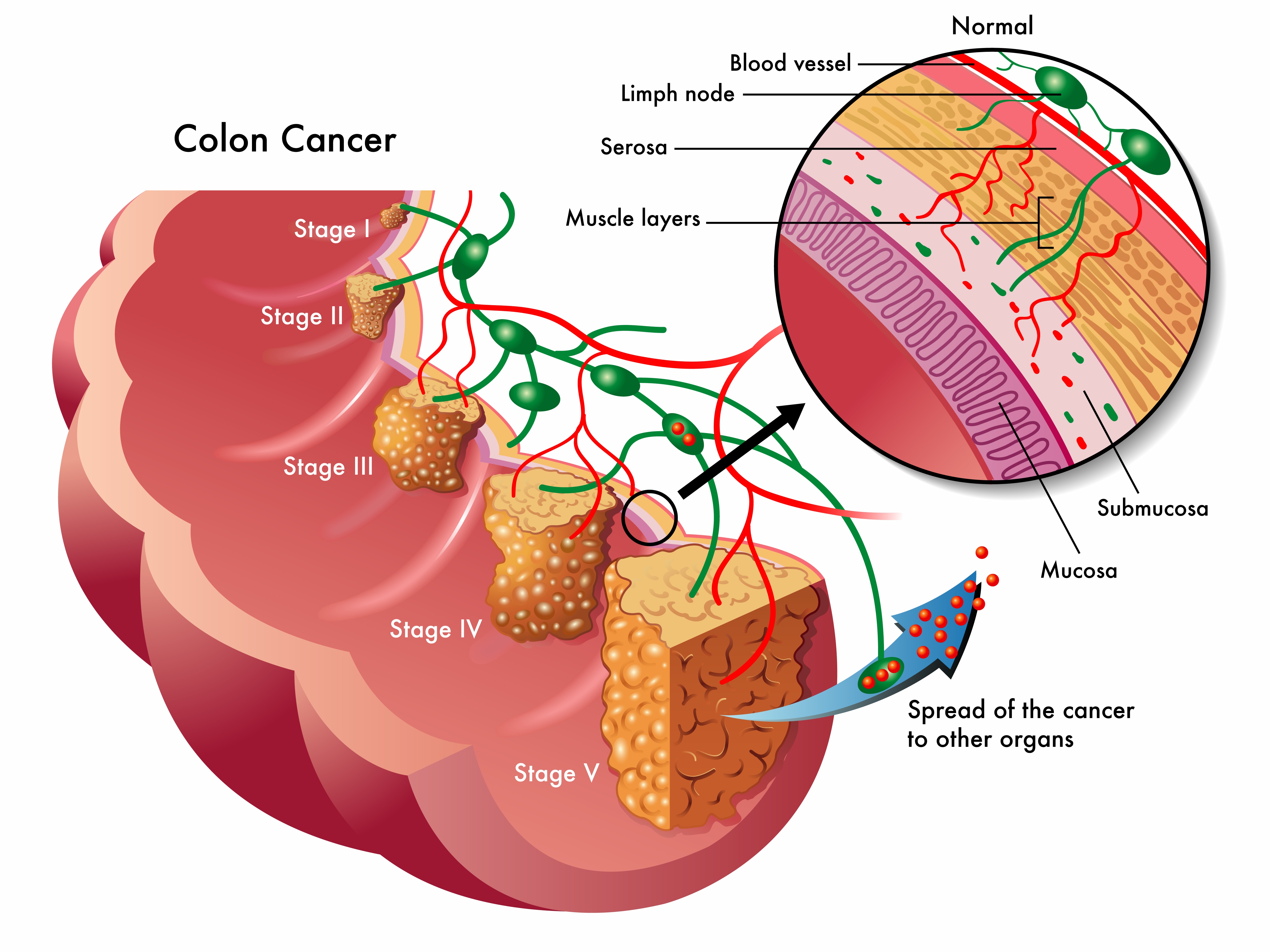 Colorectal Cancer