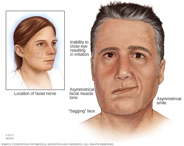 Bells Palsy - Head And Face - Surgery - What We Treat 