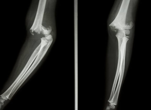 elbow fracture- Dubai pediatric clinic