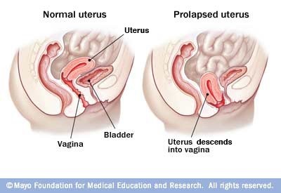 female genital prolapse prolapse