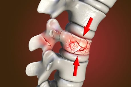 fractured vertebra