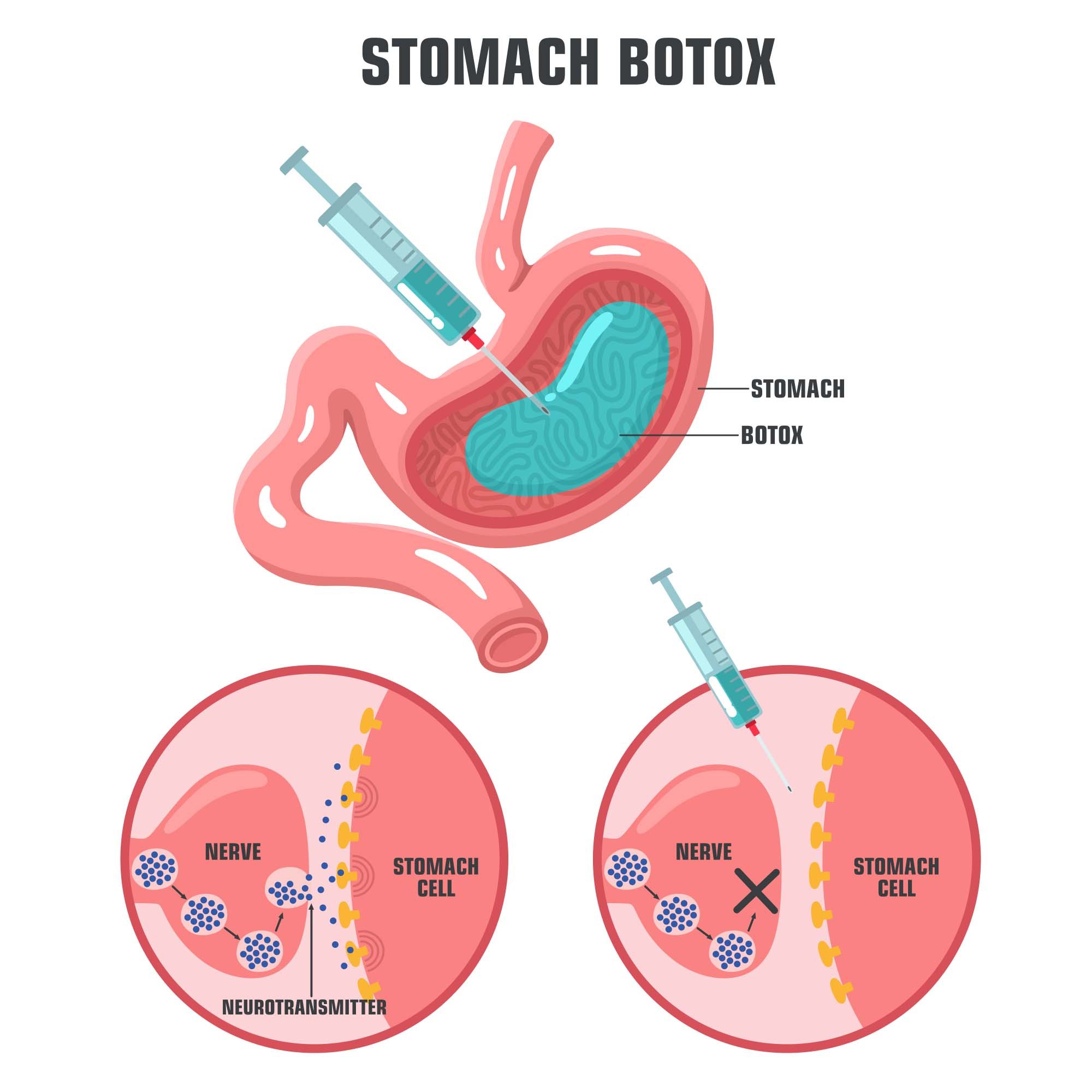gastric botox injection-1