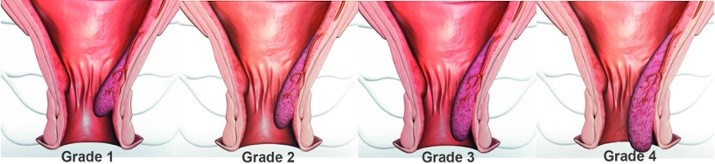  hemorrhoids grades