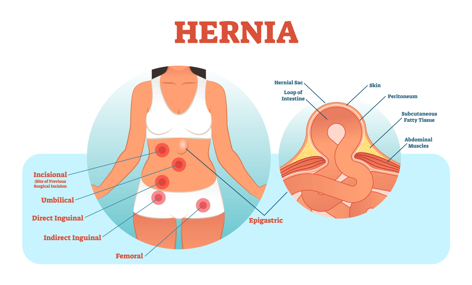 Laparoscopic Hernia Repair